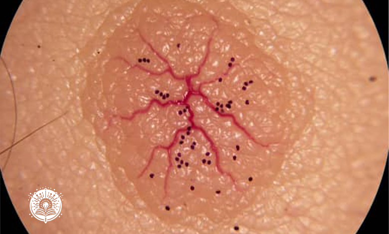 ما هو سرطان الجلد (الملانوما - Melanoma)